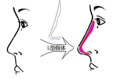 全盘解析隆鼻手术 让隆鼻不再迷雾重重