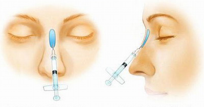 全盘解析隆鼻手术 让隆鼻不再迷雾重重
