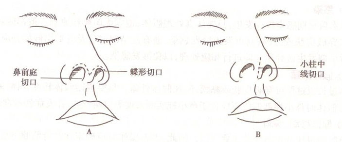如果隆鼻切口是前庭内切口,手术后虽然会留有疤痕,但疤痕比较隐蔽.