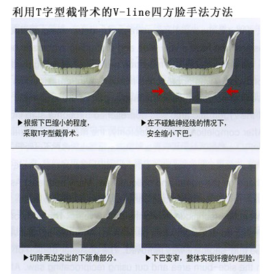 图解整形 四方脸如何变v字脸
