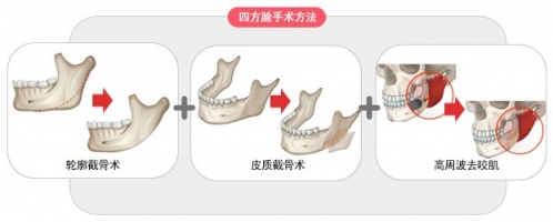 图解整形 四方脸如何变v字脸