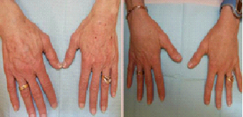 你的自体脂肪能“搬”到哪儿?