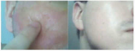 TCA 化学换肤术的术前及术后对比 TCA 化学换肤术的术前及术后对比