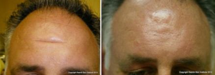 环钻切除术的术前及术后对比 环钻切除术的术前及术后对比