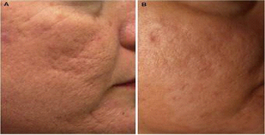 注射Sculptra(聚左旋乳酸)的术前及术后对比 注射Sculptra(聚左旋乳酸)的术前及术后对比