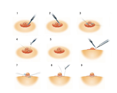乳头凹陷要重视矫正后更健康