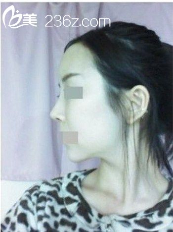 自体脂肪丰额头