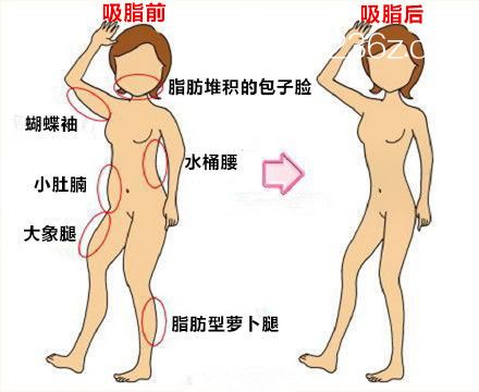 吸脂手术也有风险，你都看了吗