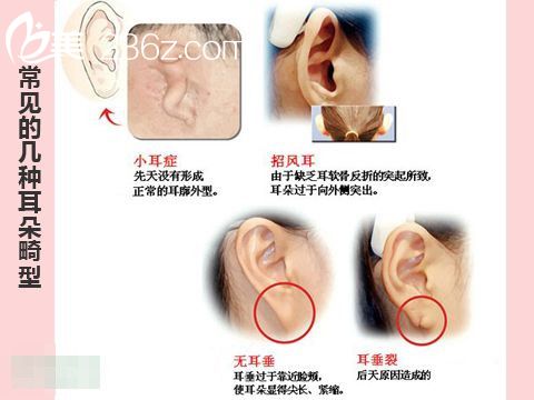 几种常见的耳部整形