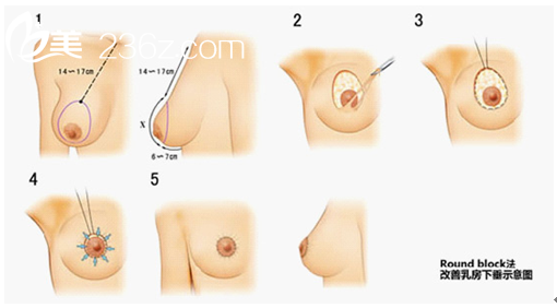 乳房下垂矫正术示意图