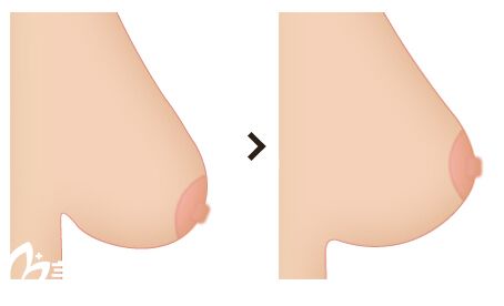 乳房下垂矫正