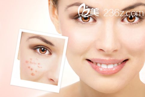 激光去痘手术 激光去痘手术