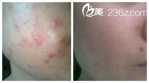 激光去痘手术前后对比图 激光去痘手术前后对比图