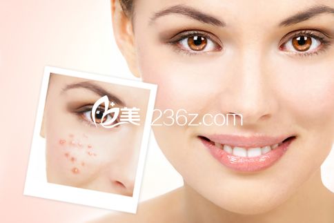 激光去痘印团购 激光去痘印团购