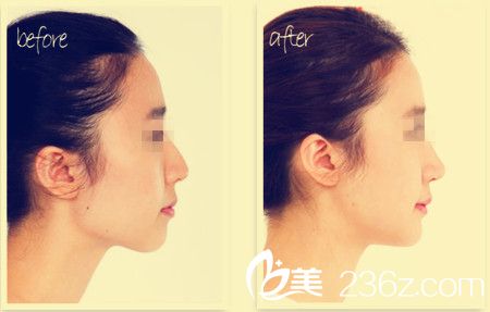 玻尿酸隆鼻前后对比图 玻尿酸隆鼻前后对比图