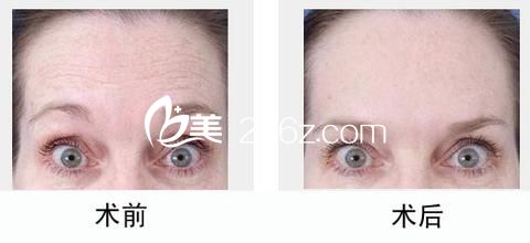 北京额头除皱手术前后对比