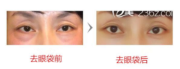 去眼袋前后效果图