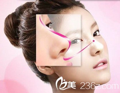 武汉鼻子整形医生为你解读鼻部整形过程！