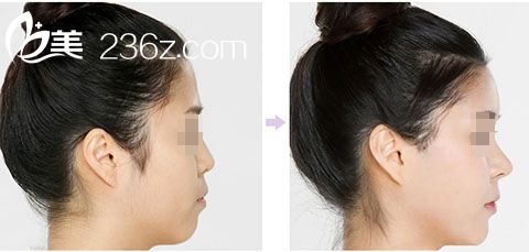 注射隆鼻手术前后对比图 注射隆鼻手术前后对比图