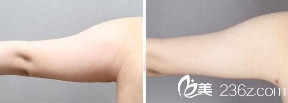 吸脂瘦手臂