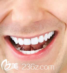 男士下颌角整形