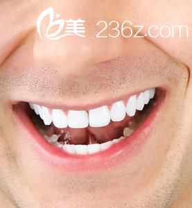 漂白牙齿 漂白牙齿