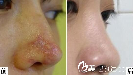 鼻整形修复案例对比图