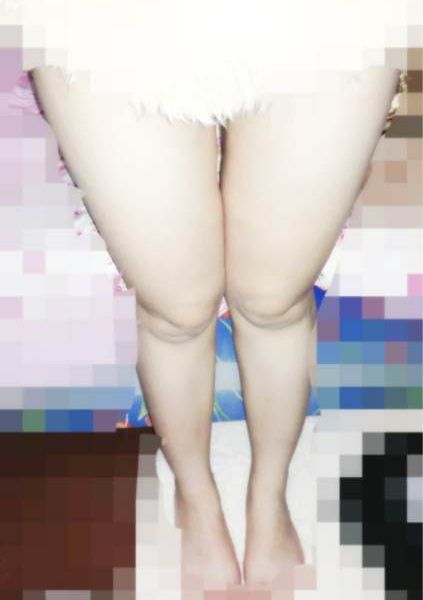 变美体验,整形体验,整形案例,整形项目,热门整形案例术前照片1