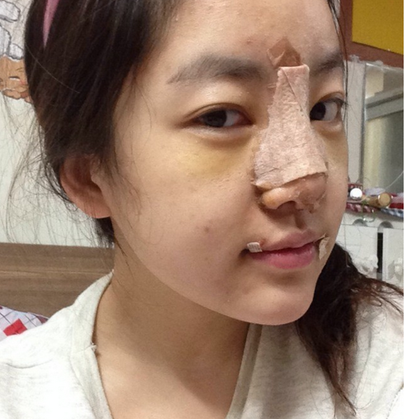 变美体验,整形体验,整形案例,整形项目,热门整形案例术前照片1