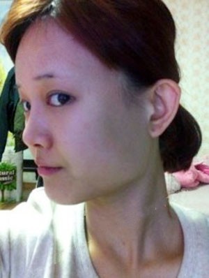 变美体验,整形体验,整形案例,整形项目,热门整形案例术前照片1