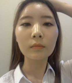 变美体验,整形体验,整形案例,整形项目,热门整形案例术前照片1