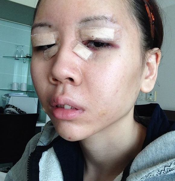 变美体验,整形体验,整形案例,整形项目,热门整形案例术前照片1