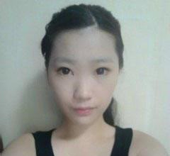 整形医院术前照片2