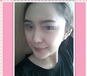 变美体验,整形体验,整形案例,整形项目,热门整形案例术后照片1