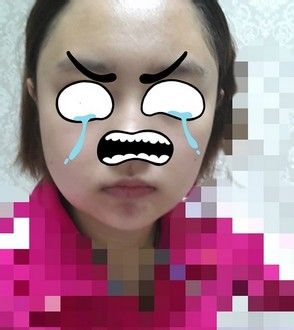 变美体验,整形体验,整形案例,整形项目,热门整形案例术前照片1