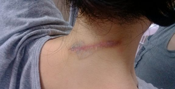 　　脖子后面有一道很长的增生疤痕，已经有一年多了，特别难看，