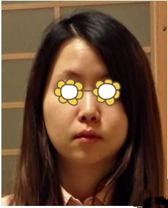 变美体验,整形体验,整形案例,整形项目,热门整形案例术前照片1