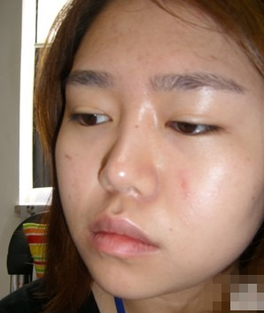 变美体验,整形体验,整形案例,整形项目,热门整形案例术后照片1