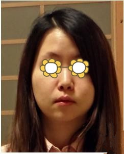 变美体验,整形体验,整形案例,整形项目,热门整形案例术前照片1