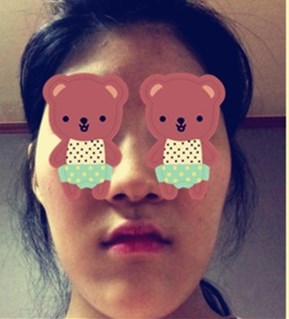 变美体验,整形体验,整形案例,整形项目,热门整形案例术前照片1