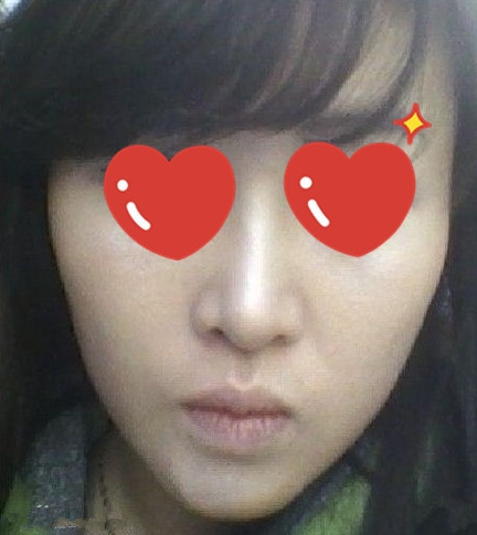 变美体验,整形体验,整形案例,整形项目,热门整形案例术后照片1