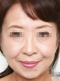 变美体验,整形体验,整形案例,整形项目,热门整形案例术后照片1