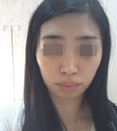 变美体验,整形体验,整形案例,整形项目,热门整形案例术前照片1