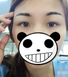 变美体验,整形体验,整形案例,整形项目,热门整形案例术前照片1