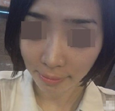 变美体验,整形体验,整形案例,整形项目,热门整形案例术后照片1