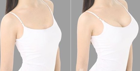 假体隆胸对比图