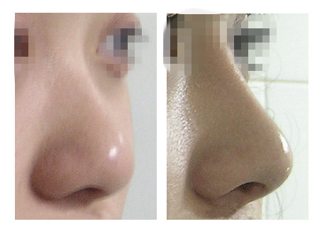 耳软骨隆鼻安全吗